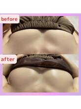 レビーリズ バイ サロンリーナ(Revie Liz)/バストアップ症例