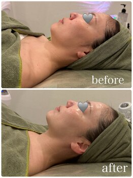 クラン 森ノ宮店(Clan)/光フェイシャル 30代女性