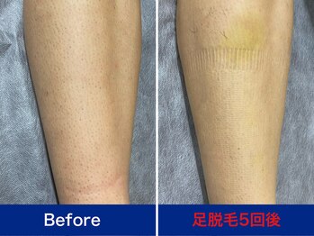 ミスターアンクール 鹿児島(Mr.uncoeur)/足脱毛5回後