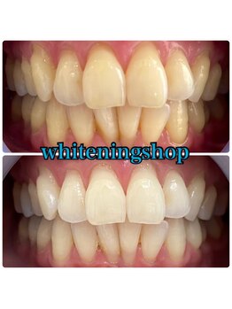 ホワイトニングショップ 山形店(Whiteningshop)/仕事帰りにホワイトニング