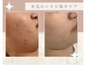 【本気の肌質改善】慢性ニキビケア・繰返すニキビケア卒業！初回体験＆ご相談