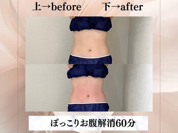 イヨヨ(iyoyo)/【痩身】 Before After