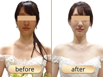 ブライダルエステ バイ スイスパ表参道(BRIDAL ESTHE by SUI SPA)/【小顔矯正】小顔 Before→After
