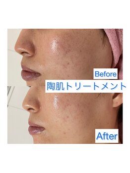 シカホワイトニングトウキョウ 笹塚店(CICA Whitening Tokyo)/REVIハーブピーリング