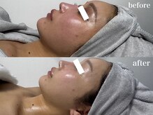 ナチュールムーン(Nature moon.)/ハーブピーリング