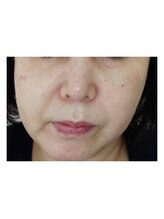 アイビー(IVY.L)/光フェイシャルの効果