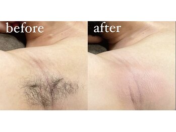 ラヴィアンクレール 梅田店(La vie en Clair)/◆脇ワックス脱毛◆