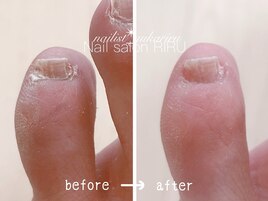 フット角質ケア