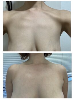 シャルマン(Charmant)/befoer、after