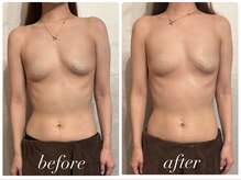 ビノスビューティー(vinos.beauty)/症例写真　上半身痩身