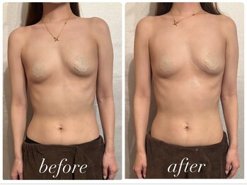 ビノスビューティー(vinos.beauty)/症例写真　上半身痩身