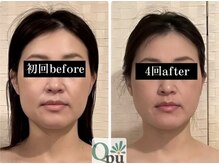 キュープ 鹿児島伊集院店(Qpu)/小顔矯正4回での変化