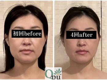 キュープ 鹿児島伊集院店(Qpu)/小顔矯正4回での変化