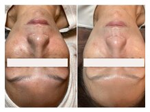 フェイスプラスリフ(FACE+RiF)/肌質改善