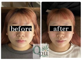 キュープ 下関店(Qpu)/通常コース4回での変化