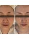 ランティル(l’until)の写真/ダイエットでも落ちない顔の脂肪。輪郭からはみ出る脂肪。二重アゴの脂肪を分解。すっきり小顔になります。