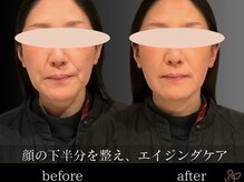 チョコバリ 恵比寿店(chocobari)/小顔リフトアップ（美容鍼）50代