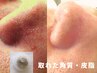 【夏肌ケア】毛穴・黒ずみ・角栓改善＋導入90分￥6600|埼玉大宮フェイシャル