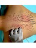 【究極！全身のコリを一度撃退！】究極のルート鍼120分コース