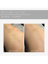 ジール(GIILL)/背中脱毛☆ビフォーアフター