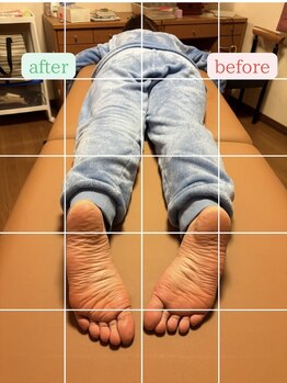 ルミナフローム(LuminaFlowm)/ビフォーアフター