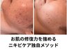 【しっかりニキビケア！】極上鎮静パック付き◆ハーブピーリング