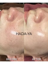 肌屋(HADA-YA)/水光セル★3回 