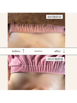 エミニナル(EMININAL)/バストケア【ビフォーアフター】