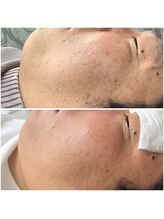 キビック(KIBIK)/メンズもシミケア