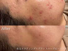 サロンヴェアリー 広尾(salon vary)/毛穴、乾燥、たるみ、シミにも