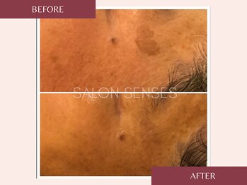 センシズ(Senses)/くすみ・シミ改善