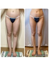 アクアモア/アクアモアの痩身★BeforeAfter