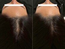 アンノン(Annon)/臍帯羊膜幹細胞の頭皮導入症例