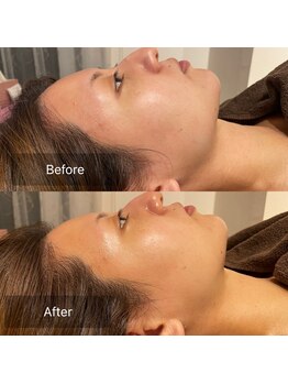 サンサンゴビューティー(335beauty)/リブセラ/施術回数1回