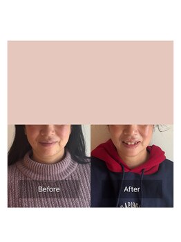 かぐや(salon)/ビフォアフ：「香り蒸」後の施術