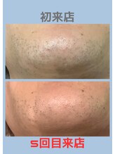 トゥルー(true)/ヒゲ脱毛　経過写真