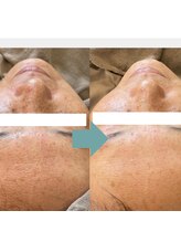 レベンディス(LEVENDIS)/ハーブピーリング×美容液導入