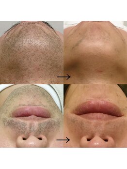 メンズサロンエヌエー(MEN'S SALON NA)/人気No. 1【ヒゲ脱毛】