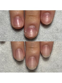 深爪矯正/継続コース4ヶ月後