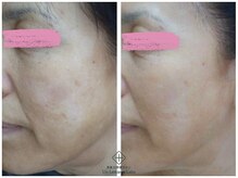 アンレミューラボ(Un Lemieux Labo)/シワ、たるみ、くすみ改善