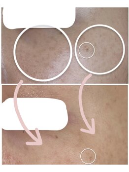 ポノ(PONO)/水光ピーリング