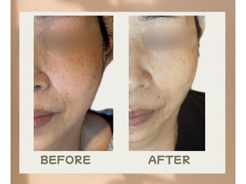 ラウレア(Laure'a)/プラズマリフト