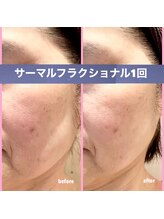 ミレボ(Me.rebo)/リフトアップ最新機器！