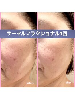 ミレボ(Me.rebo)/リフトアップ最新機器！