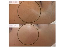 シミケア1回での変化