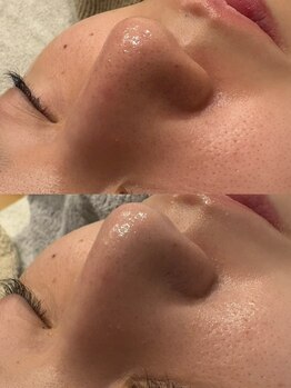ルナ(Runa)の写真/【本気でお肌をきれいにしたい方必見★】クレンジングではなかなか落とせない毛穴詰りをスッキリ解消◎
