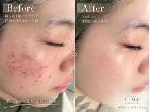 ライム 大宮(LIME)の雰囲気（【ハーブピーリング/毛穴/ニキビ/毛穴洗浄/肌質改善/美肌】）