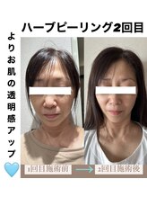 ブルーシー(BLUESEA)/【RHR】幹細胞ハーブピーリング