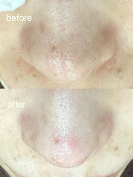 エクラ バイ シャンリィ(eclat by shanLy)/黒ずみとさよなら！