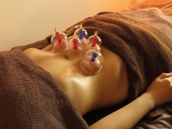 西野6条はり灸整骨院/カッピング